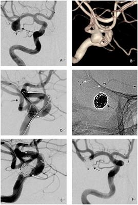 Embolization of unruptured wide-necked aneurysms at the MCA bifurcation using the Neuroform atlas stent-assisted coiling: a two-center retrospective study